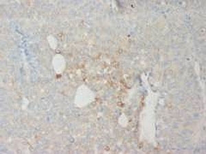 IHC-P: CD18 antibody testing of human uroepithelium cancer tissue
