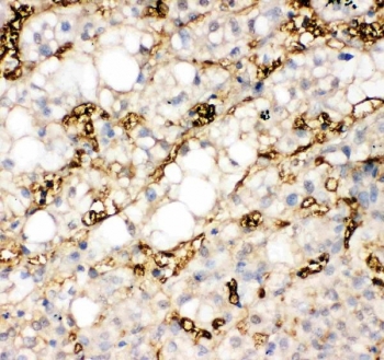 FABP1 Antibody Liver Cancer Immunohistochemistry. IHC-P: FABP1 antibody testing of human liver cancer tissue. HIER: steamed with pH6 citrate buffer.