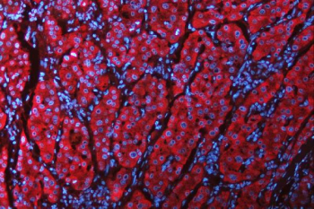 Immunofluorescent staining of FFPE human liver cancer tissue with N-Cadherin antibody (red) and DAPI nuclear stain (blue). HIER: steam section in pH8 EDTA for 20 min.