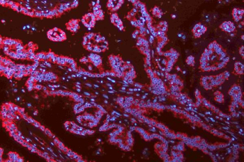Immunofluorescent staining of FFPE human lung cancer tissue with N-Cadherin antibody (red) and DAPI nuclear stain (blue). HIER: steam section in pH8 EDTA for 20 min.
