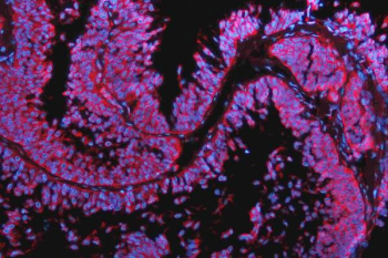 Immunofluorescent staining of FFPE human ovarian cancer tissue with N-Cadherin antibody (red) and DAPI nuclear stain (blue). HIER: steam section in pH8 EDTA for 20 min.