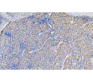 IHC staining of FFPE human liver cancer tissue with N-Cadherin antibody. HIER: boil tissue sections in pH8 EDTA for 20 min and allow to cool before testing.