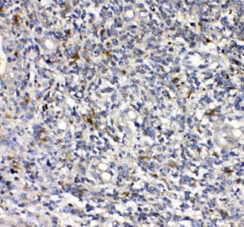 uPAR Antibody Human Glioma IHC. Immunohistochemical staining of FFPE human glioma tissue using uPAR Antibody. HIER was performed in pH 8.0 EDTA buffer. An HRP-conjugated secondary antibody with DAB substrate was used for detection. uPAR Antibody, recognizing PLAUR/uPA Receptor, demonstrates cytoplasmic and membranous staining in glioma cells, consistent with the role of uPAR as a cell invasion receptor involved in tumor cell migration, extracellular matrix remodeling, and cancer progression.