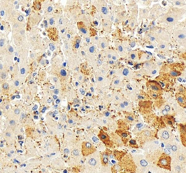 Connexin 32 Antibody / Gap Junction Protein Antibody Human Liver IHC. Immunohistochemical staining of FFPE human liver tissue using Connexin 32 Antibody / Gap Junction Protein Antibody. Connexin 32 expression is detected predominantly within hepatocyte cell membranes and cytoplasm, consistent with its role in forming gap junction channels that mediate direct intercellular communication and maintain normal liver physiology. Heat-induced epitope retrieval was performed in pH 8.0 EDTA buffer prior to staining. Tissue sections were blocked with 10% goat serum and incubated with the primary antibody (2 ug/ml) overnight at 4Â°C, followed by a peroxidase-conjugated goat anti-rabbit IgG secondary antibody. Immunoreactivity was visualized using an HRP Super Vision detection system with DAB as the chromogen.