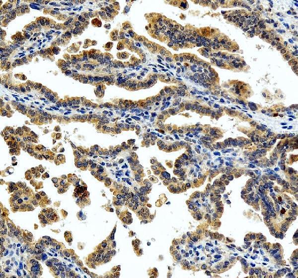 MEK1 Antibody / MAP Kinase Kinase Antibody Human Ovarian Cancer IHC. Immunohistochemical staining of FFPE human ovarian cancer tissue using MEK1 Antibody / MAP Kinase Kinase Antibody. MEK1 expression is detected predominantly within the cytoplasm of tumor cells, consistent with its role as a dual-specificity kinase that phosphorylates ERK1 and ERK2 within the RAF-MEK-ERK signaling pathway. Heat-induced epitope retrieval was performed in pH 8.0 EDTA buffer prior to staining. Tissue sections were blocked with 10% goat serum and incubated with the primary antibody (2 ug/ml) overnight at 4Â°C, followed by a peroxidase-conjugated goat anti-rabbit IgG secondary antibody. Immunoreactivity was visualized using an HRP Super Vision detection system with DAB as the chromogen.
