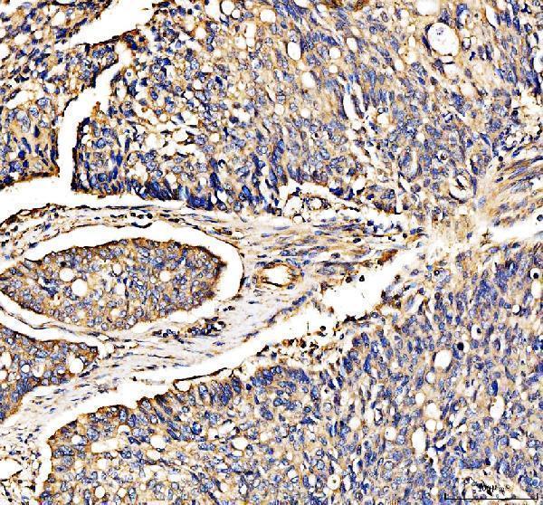 MEK3 Antibody / p38 MAP Kinase Kinase Antibody Human Colon Cancer IHC. Immunohistochemical staining of FFPE human colon cancer tissue using MEK3 Antibody / p38 MAP Kinase Kinase Antibody. MEK3 expression is detected predominantly within the cytoplasm of tumor cells, consistent with its role as a dual-specificity kinase that activates p38 MAP kinases in response to cellular stress, inflammatory cytokines, and environmental stimuli. Heat-induced epitope retrieval was performed in pH 8.0 EDTA buffer prior to staining. Tissue sections were blocked with 10% goat serum and incubated with the primary antibody (2 ug/ml) overnight at 4Â°C, followed by a peroxidase-conjugated goat anti-rabbit IgG secondary antibody. Immunoreactivity was visualized using an HRP Super Vision detection system with DAB as the chromogen.Expected/observed molecular weight ~39 kDa.