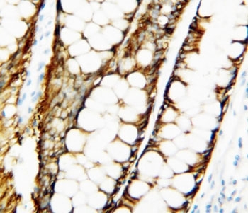 IHC-P: TIMP1 antibody testing of human breast cancer tissue