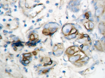 IHC-P: IP10 antibody testing of human breast cancer tissue