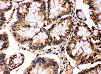 IHC testing of FFPE human intestinal cancer with MAPK8/9 antibody. HIER: boil tissue sections in pH6, 10mM citrate buffer, for 10-20 min followed by cooling at RT for 20 min.