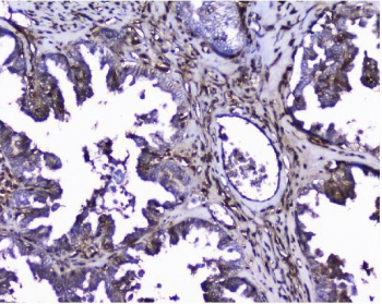 Galectin Antibody Human Ovarian Cancer IHC. Immunohistochemical staining of FFPE human ovarian cancer tissue using Galectin antibody demonstrates moderate to strong cytoplasmic and membranous HRP-DAB brown staining within malignant epithelial cells and associated stromal elements. The staining pattern is consistent with expression of Galectin-1 (LGALS1), a beta-galactoside-binding lectin involved in cell adhesion, immune modulation, extracellular matrix remodeling, angiogenesis, and tumor progression. Prominent Galectin-1 immunoreactivity within both tumor and stromal compartments highlights its role in tumor microenvironment regulation and glycan-mediated signaling pathways associated with ovarian cancer biology. HIER: boil tissue sections in pH8 EDTA for 20 min and allow to cool before testing.