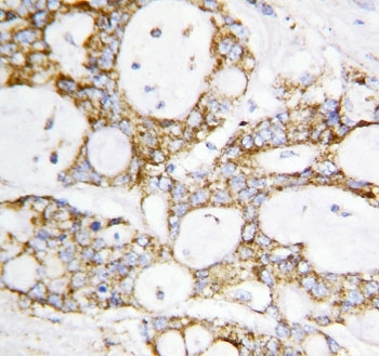 IHC staining of FFPE human breast cancer tissue with Lipoamide Dehydrogenase antibody. HIER: boil tissue sections in pH6 citrate buffer for 20 min and allow to cool before testing.