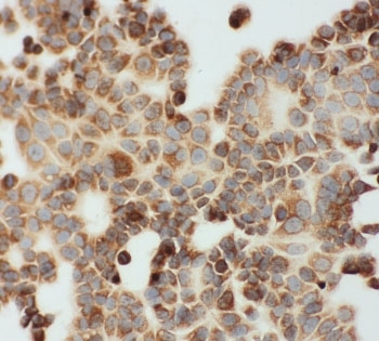 ICC staining of FFPE human MCF7 cells with Lipoamide Dehydrogenase antibody. HIER: steam section in pH6 citrate buffer for 20 min.