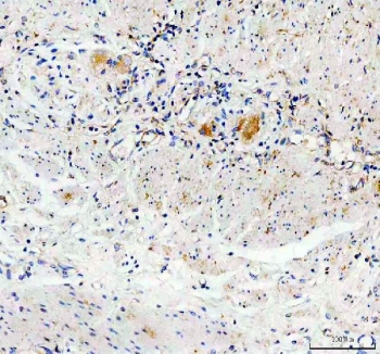 IHC staining of FFPE human stomach cancer tissue with GDNF antibody. HIER: boil tissue sections in pH8 EDTA for 20 min and allow to cool before testing.