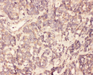 IHC testing of FFPE human gallbladder cancer tissue with FGF19 antibody at 1ug/ml. HIER: steam section in pH6 citrate buffer for 20 min.