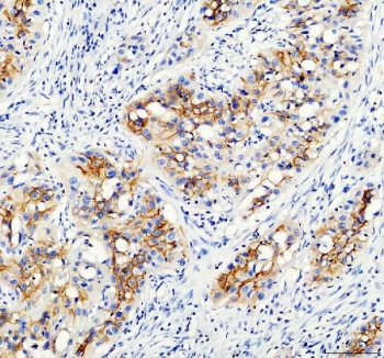 IHC staining of FFPE human bladder cancer tissue with AQP3 antibody. HIER: boil tissue sections in pH8 EDTA for 20 min and allow to cool before testing.