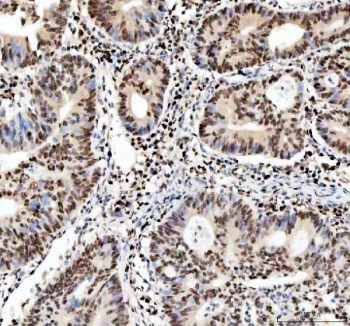 IHC staining of FFPE human colon adenocarcinoma tissue with APEX1 antibody. HIER: boil tissue sections in pH8 EDTA for 20 min and allow to cool before testing.