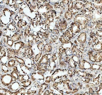 IHC staining of FFPE human prostate cancer tissue with APEX1 antibody. HIER: boil tissue sections in pH8 EDTA for 20 min and allow to cool before testing.