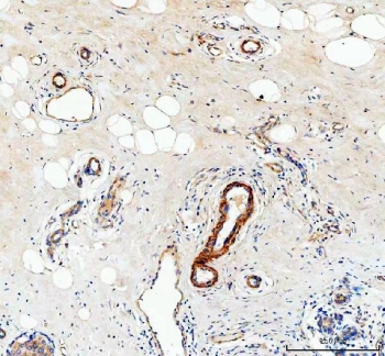 IHC testing of FFPE human breast cancer tissue with Canstatin / Collagen IV antibody at 1ug/ml. Required HIER: steam section in pH8 EDTA buffer for 20 min and allow to cool prior to staining.
