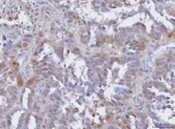 IHC staining of FFPE human ovarian adenoma tissue with BCAT1 antibody. HIER: boil tissue sections in pH8 EDTA for 20 min and allow to cool before testing.