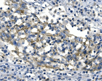 Desmoglein 2 Antibody Lung Cancer IHC. Immunohistochemistry analysis of FFPE human lung cancer tissue stained with Desmoglein 2 antibody detecting DSG2. Tumor epithelial cells show membranous and cytoplasmic staining, with accentuation along cell-cell borders consistent with localization of DSG2 in desmosomal adhesion complexes that support epithelial cohesion. Surrounding stromal and inflammatory cells show reduced staining. Hematoxylin counterstain highlights nuclei in blue. HIER: boil tissue sections in pH 8 EDTA buffer for 20 min and allow to cool before testing.
