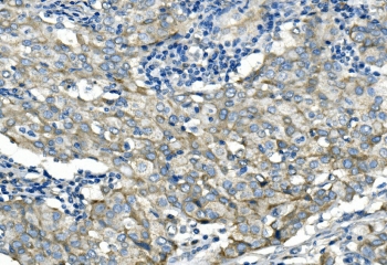 Desmoglein 2 Antibody Breast Cancer IHC. Immunohistochemistry analysis of FFPE human breast cancer tissue stained with Desmoglein 2 antibody detecting DSG2. Tumor epithelial cells demonstrate membranous and cytoplasmic staining with clear accentuation at cell-cell junctions, consistent with localization of DSG2 within desmosomal adhesion complexes that maintain epithelial structural integrity. Adjacent stromal elements show minimal staining. Hematoxylin counterstain highlights nuclei in blue. HIER: boil tissue sections in pH 8 EDTA buffer for 20 min and allow to cool before testing.