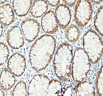 Immunohistochemical staining of FFPE human colon cancer tissue with GRB7 antibody, HRP-secondary and DAB substrate. HIER: boil tissue sections in pH8 EDTA for 20 min and allow to cool before testing.
