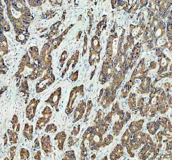 Immunohistochemical staining of FFPE human stomach cancer tissue with GRB7 antibody, HRP-secondary and DAB substrate. HIER: boil tissue sections in pH8 EDTA for 20 min and allow to cool before testing.
