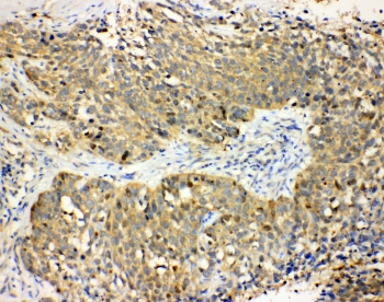 IHC-P: Haptoglobin antibody testing of human lung cancer tissue