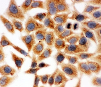 HSD17B1 Antibody Human HeLa Cell ICC. Immunocytochemistry staining of FFPE human HeLa cells using HSD17B1 Antibody demonstrates strong cytoplasmic HRP-DAB brown staining throughout the majority of cellular populations. The staining pattern is consistent with expression of Hydroxysteroid 17-Beta Dehydrogenase 1 (HSD17B1), a steroidogenic enzyme that catalyzes the conversion of estrone to biologically active estradiol and contributes to regulation of estrogen biosynthesis and steroid hormone metabolism. Predominantly cytoplasmic localization is consistent with the established intracellular enzymatic function of HSD17B1 in hormone-responsive cellular pathways. Required HIER: steam sections in pH 6 citrate buffer for 20 minutes before testing.