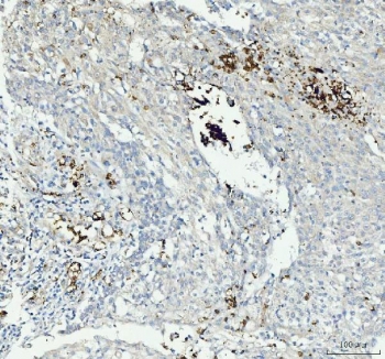 IHC staining of FFPE human laryngeal squamous cell carcinoma tissue with Integrin beta 3 antibody. HIER: boil tissue sections in pH8 EDTA for 20 min and allow to cool before testing.
