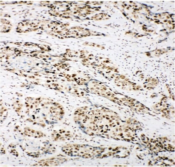 Ku80 Antibody Lung Cancer IHC. Immunohistochemistry staining of FFPE human lung cancer with Ku80 antibody. HIER: boil tissue sections in pH8 EDTA for 20 min and allow to cool before testing.