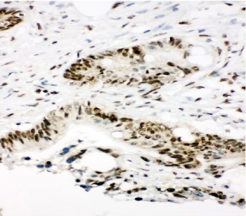 Ku80 Antibody Intestine Cancer IHC. Immunohistochemistry staining of FFPE human intestinal cancer with Ku80 antibody. HIER: boil tissue sections in pH8 EDTA for 20 min and allow to cool before testing.