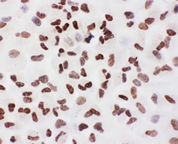Ku70 Antibody A549 Cell ICC. Immunocytochemistry testing of FFPE human A549 cells. HIER: steam section in pH6 citrate buffer for 20 min.