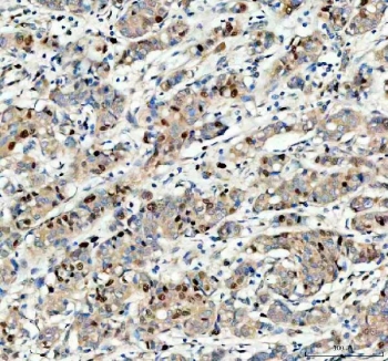 IHC staining of FFPE human breast cancer tissue with MCM3 antibody. HIER: boil tissue sections in pH8 EDTA for 20 min and allow to cool before testing.
