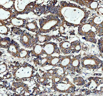 Immunohistochemistry analysis of MYD88 expression in human colon cancer tissue. Paraffin-embedded human colon cancer sections were subjected to heat-mediated antigen retrieval in EDTA buffer (pH 8.0) and incubated with anti-MYD88 antibody, followed by HRP-conjugated secondary antibody and DAB chromogen development. MYD88 staining is observed mainly in tumor-associated epithelial cells and infiltrating immune cells, consistent with cytoplasmic adaptor protein localization, with hematoxylin nuclear counterstain (blue).