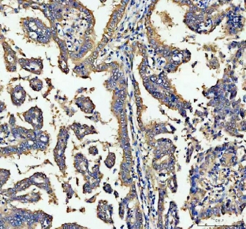 IHC staining of FFPE human lung cancer tissue with ALDH1A1 antibody. HIER: boil tissue sections in pH8 EDTA for 20 min and allow to cool before testing.