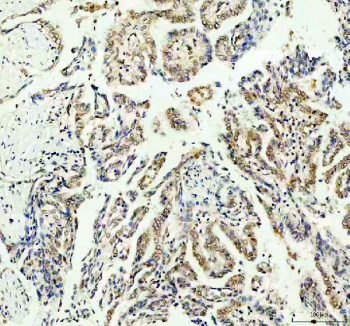 IHC staining of FFPE human lung cancer tissue with STAT6 antibody. HIER: boil tissue sections in pH8 EDTA for 20 min and allow to cool before testing.