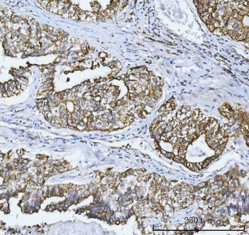 IHC testing of FFPE human lung adenocarcinoma tissue with COX-2 antibody. HIER: boil tissue sections in pH8 EDTA for 20 min and allow to cool before testing.