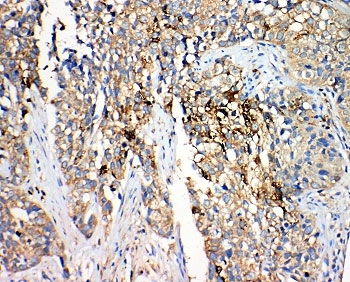IHC-P: 17-beta-Hydroxysteroid dehydrogenase 4 antibody testing of human lung cancer tissue. Required HIER: steam section in pH6 citrate buffer for 20 min.