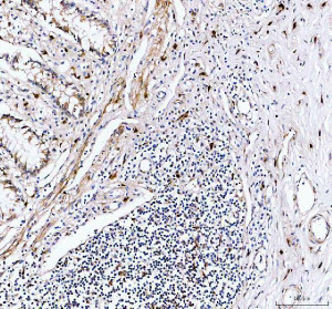 Granzyme B Antibody Human Appendix Lymphoid Tissue IHC. Immunohistochemical staining of FFPE human appendix tissue using GZMB Antibody at 2 ug/ml. HIER was performed in pH 8.0 EDTA buffer. An HRP-conjugated goat anti-rabbit IgG secondary antibody with DAB substrate was used for detection. Granzyme B Antibody, a Cytotoxic Lymphocyte Marker Antibody, demonstrates strong granular cytoplasmic staining in scattered lymphocytes within the appendiceal lymphoid aggregates, consistent with granzyme B expression in activated cytotoxic T lymphocytes and natural killer cells.