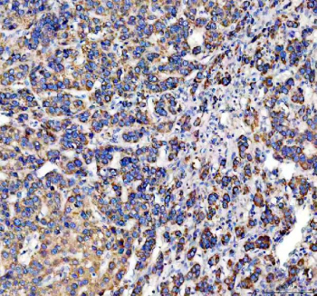 IHC analysis of DCI Antibody / Dodecenoyl-CoA delta isomerase (ECI1). ECI1 expression was examined in a paraffin-embedded section of human liver cancer tissue. Following heat-mediated antigen retrieval in EDTA buffer (pH 8.0), tissue sections were blocked with goat serum and incubated with a rabbit anti-ECI1 antibody. Immunoreactivity was visualized using an HRP-based detection system with DAB chromogen. Strong cytoplasmic staining is observed in tumor cells, consistent with the expected mitochondrial localization of ECI1 in metabolically active hepatic tissue.