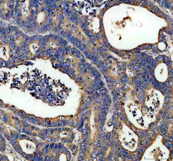 IHC analysis of DCI Antibody / Dodecenoyl-CoA delta isomerase (ECI1). ECI1 expression was examined in a paraffin-embedded section of human colon cancer tissue. Following heat-mediated antigen retrieval in EDTA buffer (pH 8.0), tissue sections were blocked with goat serum and incubated with a rabbit anti-ECI1 antibody. Immunoreactivity was visualized using an HRP-based detection system with DAB chromogen. Cytoplasmic staining is observed in tumor epithelial cells, consistent with the mitochondrial localization of ECI1, while surrounding stromal areas show lower background signal.
