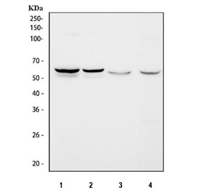 IHC staining of FFPE human breast cancer tissue with SPTLC1 antibody. HIER: boil tissue sections in pH8 EDTA for 20 min and allow to cool before testing.