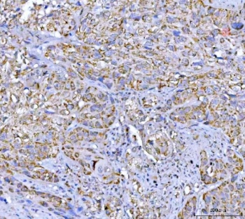 IHC staining of FFPE human urothelial carcinoma tissue with VDAC1 antibody. HIER: boil tissue sections in pH8 EDTA for 20 min and allow to cool before testing.