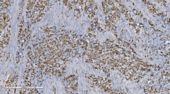 Aryl Hydrocarbon Receptor Antibody Gastric Cancer IHC. Immunohistochemical staining of FFPE human gastric cancer tissue demonstrates AHR expression using an Aryl Hydrocarbon Receptor antibody. AHR, also known as an Environmental Sensor Protein, is a ligand activated transcription factor that integrates signals from xenobiotics, dietary metabolites, and inflammatory pathways to regulate gene expression and cellular homeostasis. Predominantly nuclear and cytoplasmic staining is observed throughout malignant cells, consistent with active AHR signaling and its emerging role in tumor progression and metabolic adaptation. Heat induced epitope retrieval was performed by boiling tissue sections in pH 8 EDTA buffer for 20 minutes followed by cooling prior to staining. These findings support the utility of AHR Antibody for studies of cancer biology, toxicology, and transcriptional regulation.