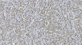 Aryl Hydrocarbon Receptor Antibody Lymphadenoma IHC. Immunohistochemical staining of FFPE human lymphadenoma tissue demonstrates AHR expression using an Aryl Hydrocarbon Receptor antibody. AHR, also known as an Environmental Sensor Protein, is a ligand activated transcription factor that regulates immune cell differentiation, inflammatory signaling, and cellular responses to endogenous and environmental ligands. Diffuse nuclear and cytoplasmic staining is observed throughout the lymphoid tumor cells, consistent with the established role of AHR in modulating immune homeostasis and hematopoietic cell function. Heat induced epitope retrieval was performed by boiling tissue sections in pH 8 EDTA buffer for 20 minutes followed by cooling prior to staining. These results support the utility of AHR Antibody for studies of immunology, lymphoid malignancies, and signal transduction pathways.