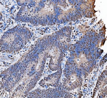 MCM7 Antibody Rabbit Polyclonal - immunohistochemistry of human rectal adenocarcinoma tissue. FFPE human moderately differentiated rectal adenocarcinoma tissue was stained with MCM7 Antibody Rabbit Polyclonal to detect Minichromosome maintenance protein 7 / MCM7. HRP-DAB brown chromogenic signal highlights predominantly nuclear staining in tumor epithelial cells within glandular gland structures, consistent with the nuclear localization of this DNA replication licensing factor in proliferating carcinoma cells. Hematoxylin counterstain marks cell nuclei (blue). Heat-induced epitope retrieval was performed by boiling tissue sections in pH8 EDTA buffer for 20 minutes and allowing sections to cool prior to staining.