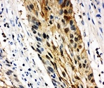 IHC-P: 14-3-3 sigma antibody testing of human oesophagus squama cancer tissue. HIER: boil tissue sections in pH6, 10mM citrate buffer, for 20 min and allow to cool before testing.
