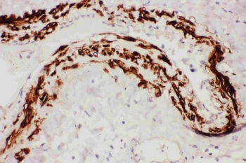 IHC staining of FFPE human lung cancer tissue with TFPI antibody. HIER: boil tissue sections in pH6 citrate buffer for 20 min and allow to cool before testing.