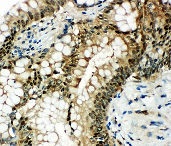 IHC-P: HSP70 antibody testing of human intestinal cancer tissue.